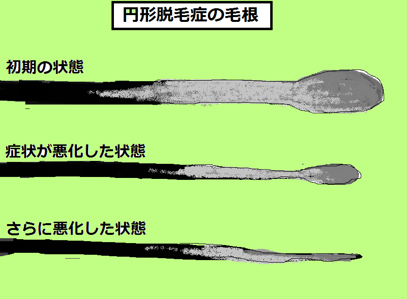 円形脱毛症とは何か 原因と対策を知りましょう 頭皮のトラブルなぜ起こる 知ることで解決策が見えてくる